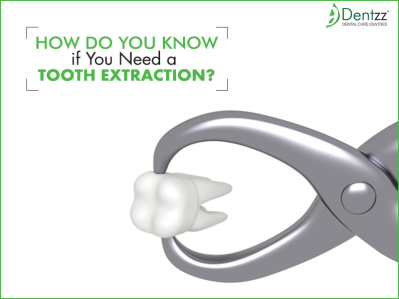 Tooth Extraction at Dentzz